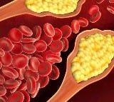 Covid infection spiked high cholesterol risk by 30pc: Study