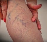 25 per cent of Indians affected by Varicose Veins, say health experts