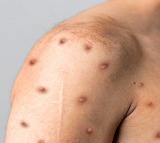US confirms first case of clade I mpox in California