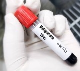 Third HMPV case identified in Gujarat