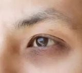 Dark Circles Are Red Flag Symptoms of THIS Potentially Dangerous Condition That Causes Breathlessness