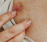 high cholesterol signs that show on skin