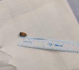 Hyderabad doctors remove pen cap stuck in man’s lungs for 21 years