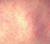 Measles outbreak spreads in US