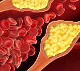 Reduce your bad cholesterol levels to keep Alzheimer’s, dementia at bay