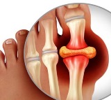 Top Foods That Help Control Uric Acid Levels