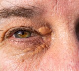 Cholesterol Detect High Cholesterol Levels by Examining Your Eyes