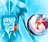 Bowel Cancer Silent Killer in Youth