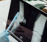 Indian researchers develop diagnostic device to detect early-stage bone cancer