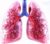 Lung TB: Higher dose of rifampicin safe, can boost recurrence-free survival, says ICMR study