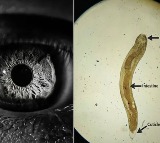 Worm In Eye Leaves Indian Man With Blurred Vision US Study Finds