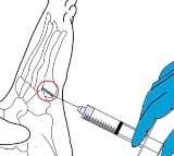 Lin Shanfeng Chinese Researchers Invent Bone Mending Glue