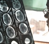 More than 1 in 3 people worldwide live with brain disorders, 11 million die annually: Report