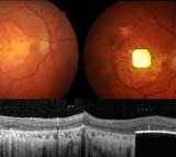 New retinal implant restores vision in patients with irreversible blindness