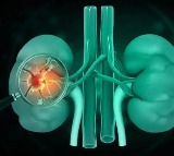 Chronic Kidney Disease Haunts Hyderabad Youth No Diabetes BP Needed