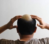 Hair Regrowth Serum in 20 Days Truth Behind the Claim