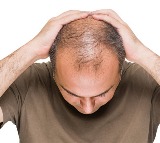 Hair Loss Causes Solutions for Youth