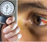 High Blood Pressure Threatens Eyesight Warns Doctors