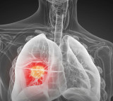 Lung cancer can be detected five years early with a drop of blood