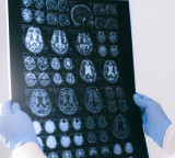 Magic Mushrooms result in recovery after five years of memory loss