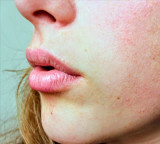 Heat Rash Home Remedies Found In Your Refrigerator To Treat Itching And Redness