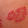 Skin Rashes also a symptom of Coronavirus positive