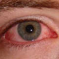 Eye strain may be a symptom of Corona 