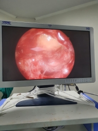 Doctors successfully removed an orbital tumor in a Woman's eye