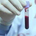 People With Blood Type A More Vulnerable To Coronavirus